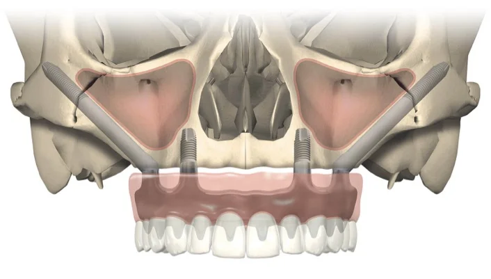 zygoma-04feb847